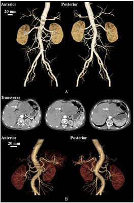 Hepatic Hemangiomas Alter Morphometry and Impair Hemodynamics of the Abdominal Aorta and Primary Branches From Computer Simulations